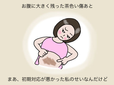 お腹に大きく残った茶色い傷あと まあ、初期対応が悪かった私のせいなんだけど