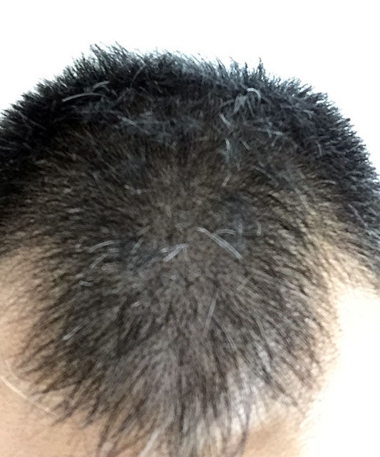 発毛効果 41日目 M字ハゲでも安心できない ハゲが進行した 若ハゲを自分で治療して治す Aga発毛育毛剤効果体験談 発毛効果 41日目 M字ハゲでも安心できない ハゲが進行した 若ハゲを自分で治療して治す Aga発毛育毛剤効果体験談