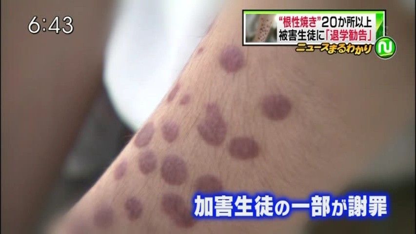 画像 高2の腕に20カ所 根性焼き 学校 お前の火傷を見ると他の生徒が気分悪くなる 退学しろ 神速 画像 高2の腕に20カ所 根性焼き 学校 お前の火傷を見ると他の生徒が気分悪くなる 退学しろ 神速