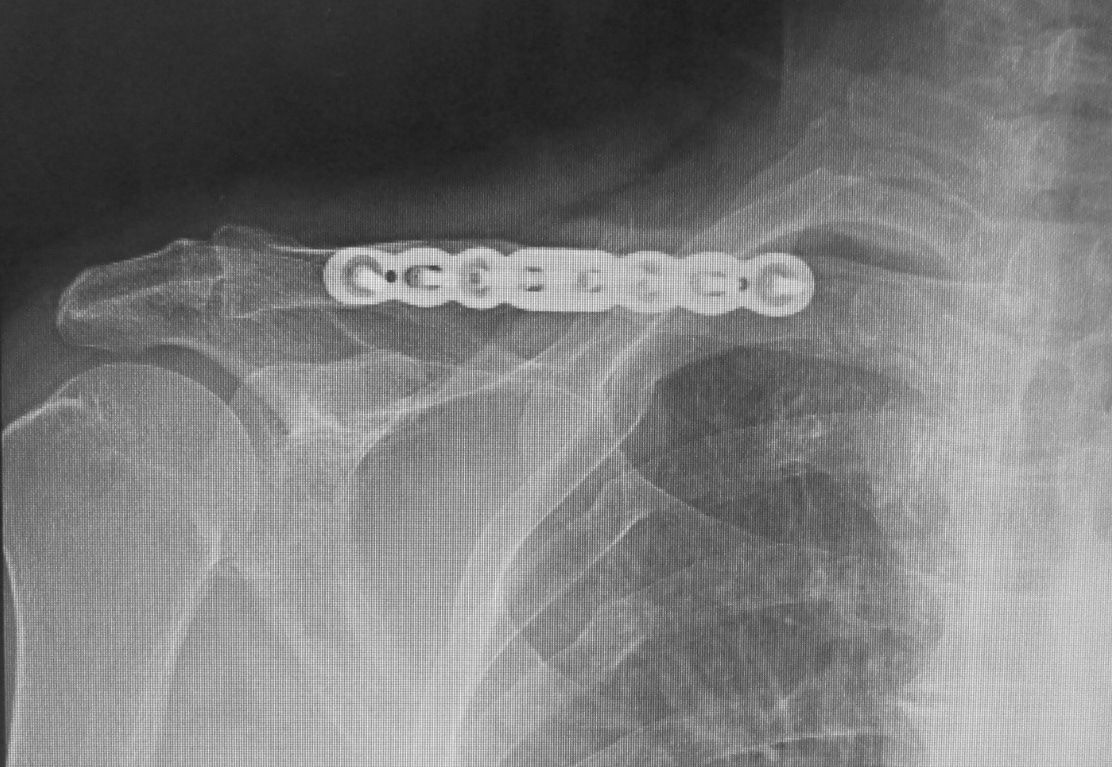 鎖骨骨折の前方プレート 50代整形外科医の手術記録