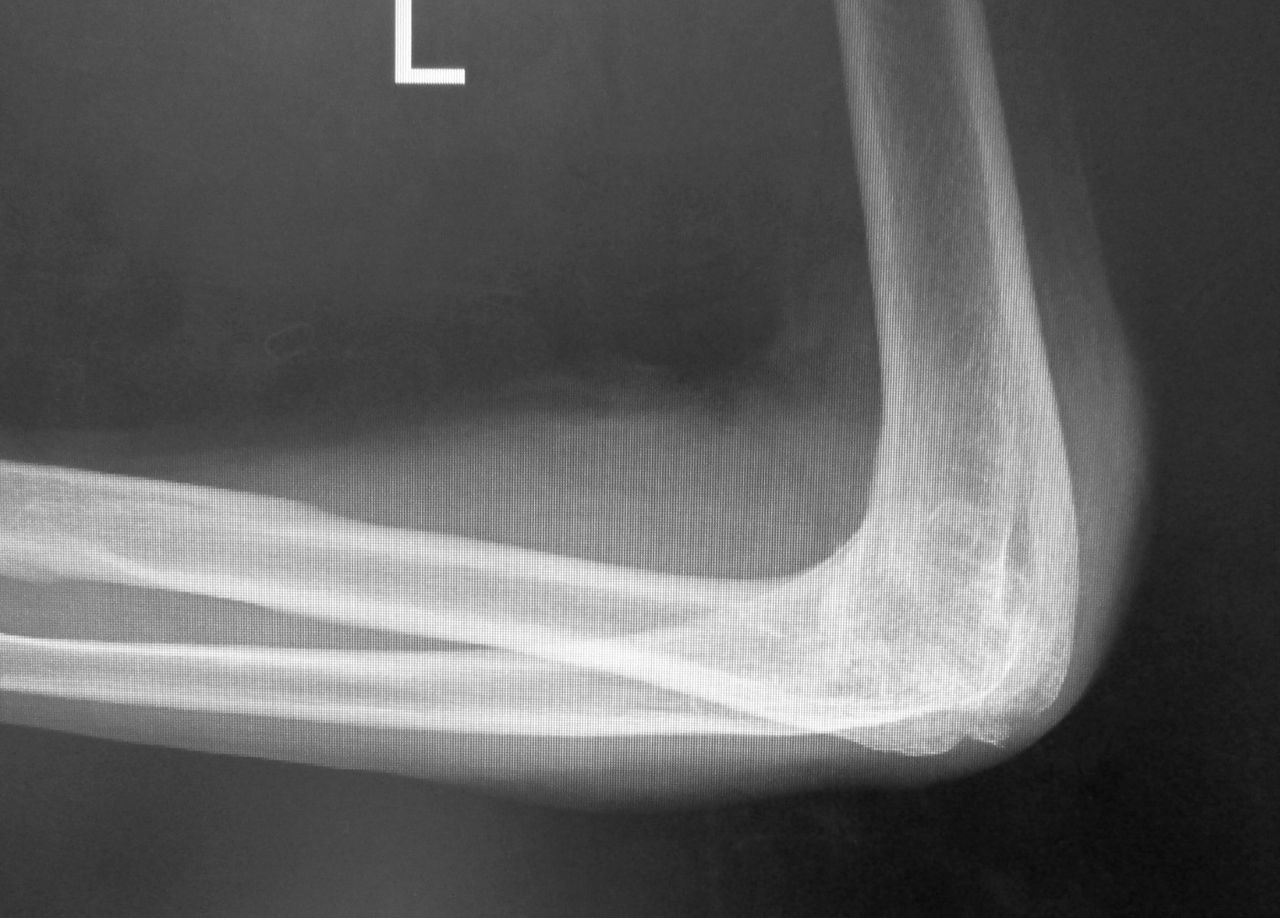 強直肘の骨折 50代整形外科医の手術記録