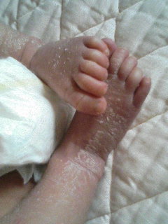 新生児 脱皮 新生児の手足が乾燥してカサカサになる理由や対処法はこれ Tmh Io