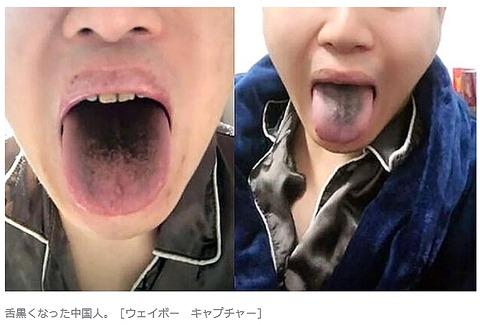 舌が黒くなった中国人