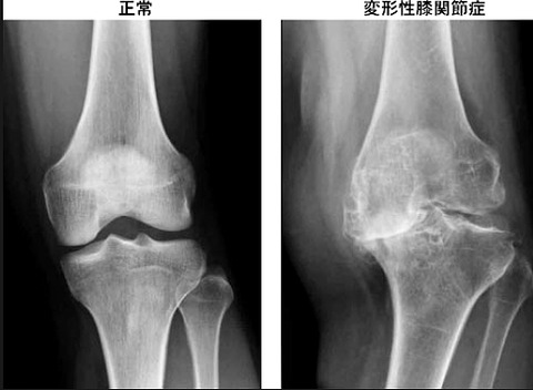 変形性膝関節症レントゲン比較