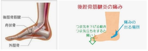 後脛骨筋腱炎