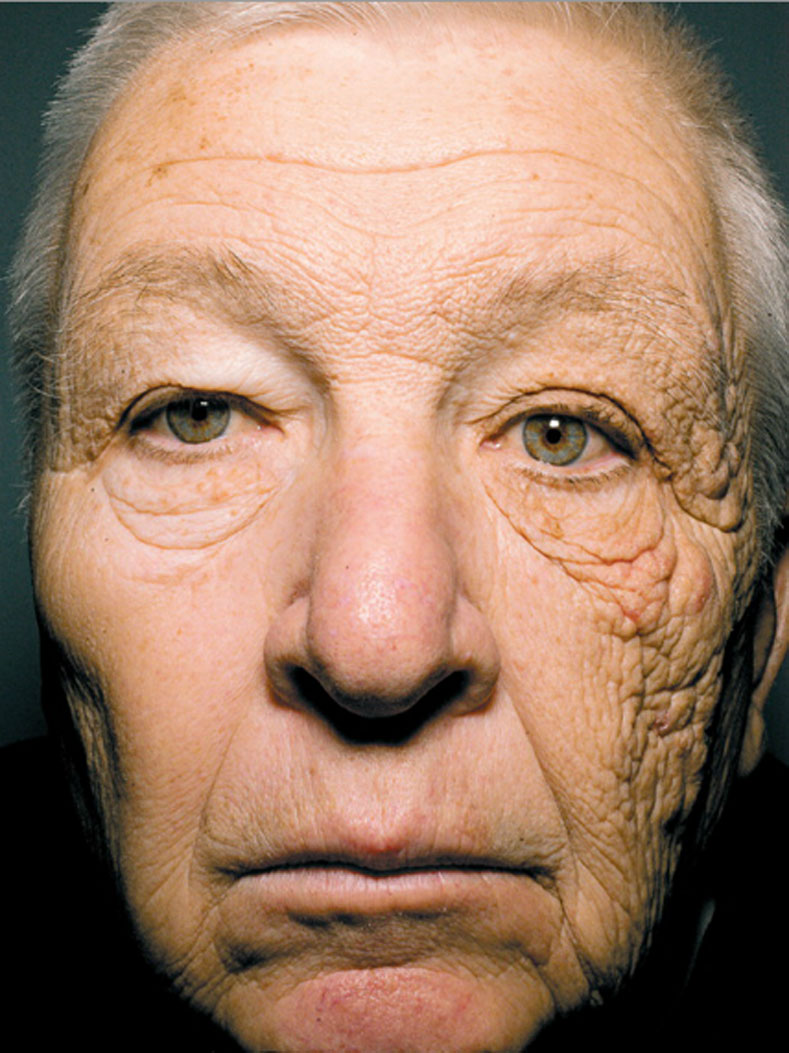 左側だけ太陽光を28年間浴び続けたトラック運転手、顔の左右で老化に大きな差が（米研究） : カラパイア