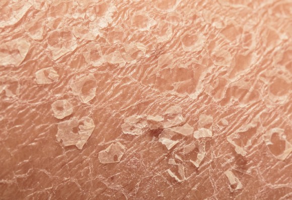 アトピー性皮膚炎の根本的原因がついに突き止められる 効果的な治療につながることが期待される 英研究 カラパイア