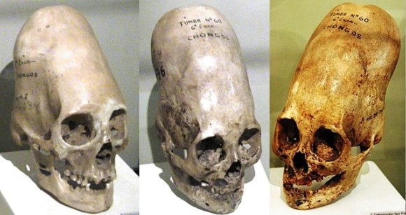 ペルーで発見された長く変形した頭蓋骨は 人工頭蓋変形 ではなく先天的な遺伝子異常によるもの 最新のdna検査結果が発表される カラパイア