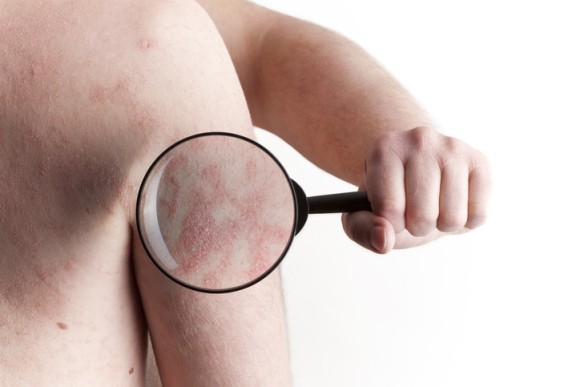 アトピー性皮膚炎の治療に光明。大きな改善効果が期待される注射が開発される（英研究）