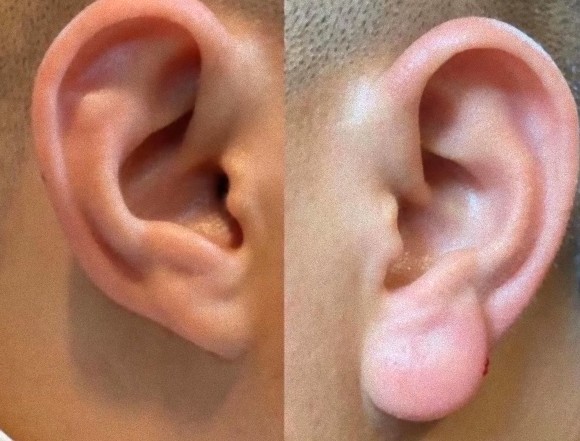 「仏の耳」がベトナムで流行中。耳たぶにヒアルロン酸を注入する男性が続出