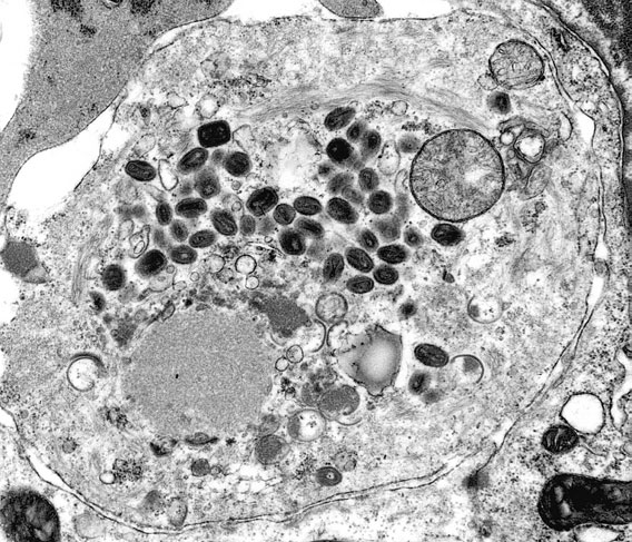 Smallpox