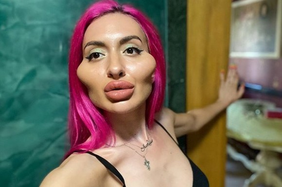後悔はしていない 自分の理想はこの形 頬骨を強調するための整形を繰り返す女性 ウクライナ カラパイア