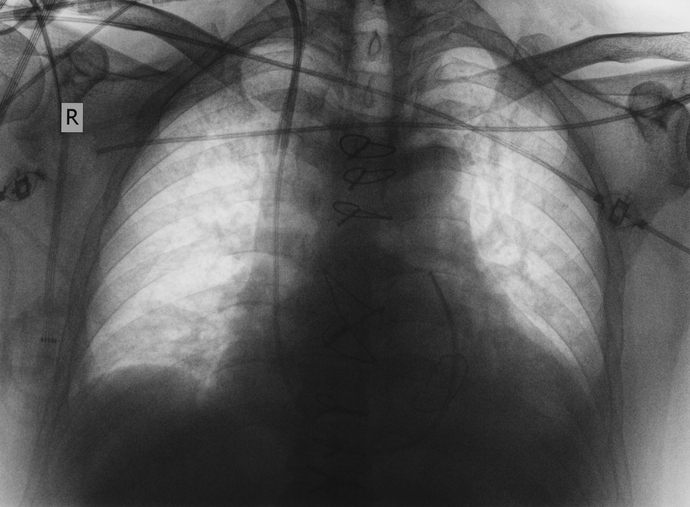 科学の名のもとに。自分の静脈にカテーテルを突っ込みノーベル賞を受賞した医師「ヴェルナー・フォルスマン」の物語