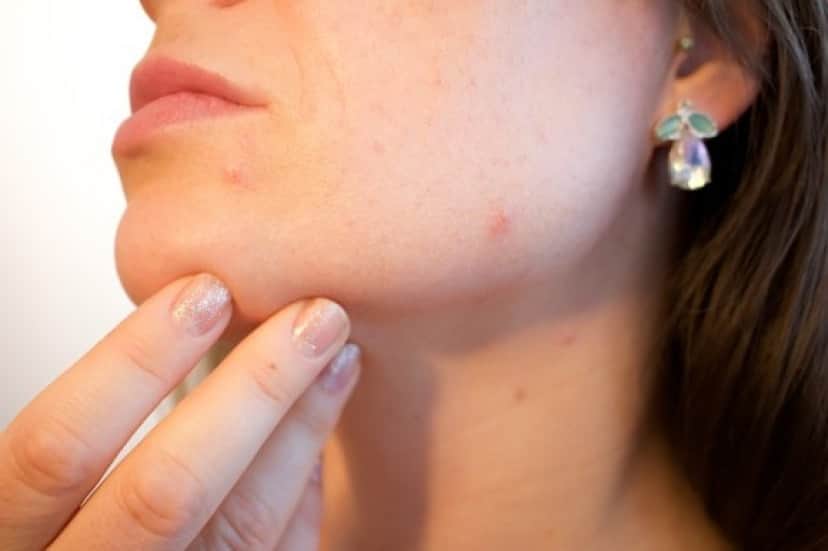 acne-1606765_640_e