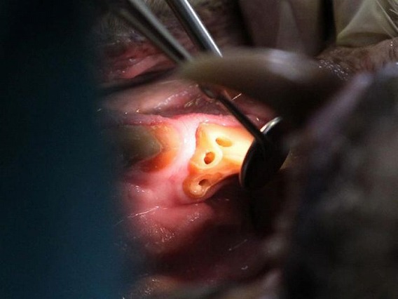 tiger_root_canal_05
