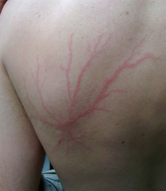 落雷による傷跡 人体に刻まれた稲妻のような樹状の図形 リヒテンベルク図形 閲覧微注意 カラパイア