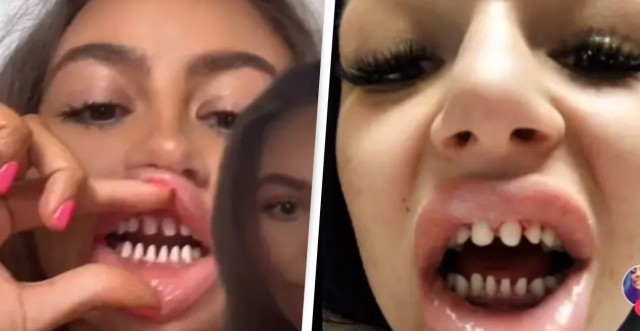 白く美しい歯を手に入れるため 一旦健康な歯を削り サメの歯 にする施術に歯科医が警告 カラパイア