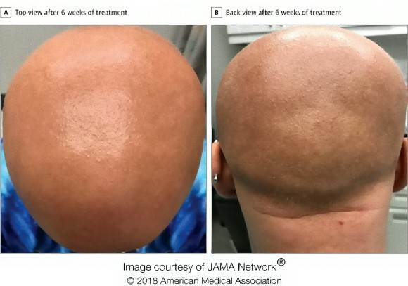 新たに承認された皮膚炎治療薬に思わぬ発毛効果 全頭性脱毛症の少女の髪の毛が劇的に生える 米研究 カラパイア