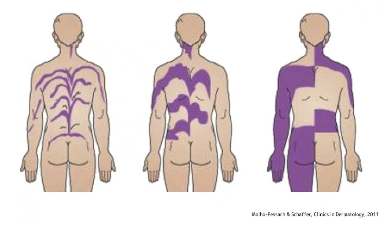 人間の皮膚に刻まれた隠れた模様「ブラシュコ線」