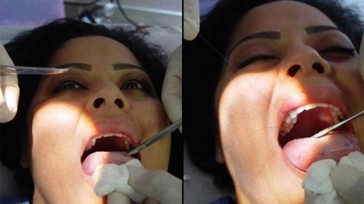 痛みを伴うダイエット法 舌に激痛が走り食べることを断念 ミラクルパッチ減量法 カラパイア