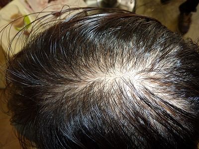 若年性薄毛 Sanc 髪の病院 の心ブログ 若年性薄毛 Sanc 髪の病院 の心ブログ