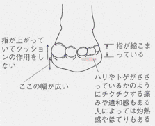 外反母趾と足裏の痛み モートン病 も同じメカニズム その１ 外反母趾ブログ