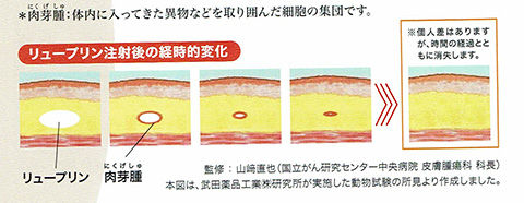放射線肺炎になっちゃった リュープリンも打ってきたよ ここちよい私を探して 乳がんになんか負けない 放射線肺炎になっちゃった リュープリンも打ってきたよ ここちよい私を探して 乳がんになんか負けない