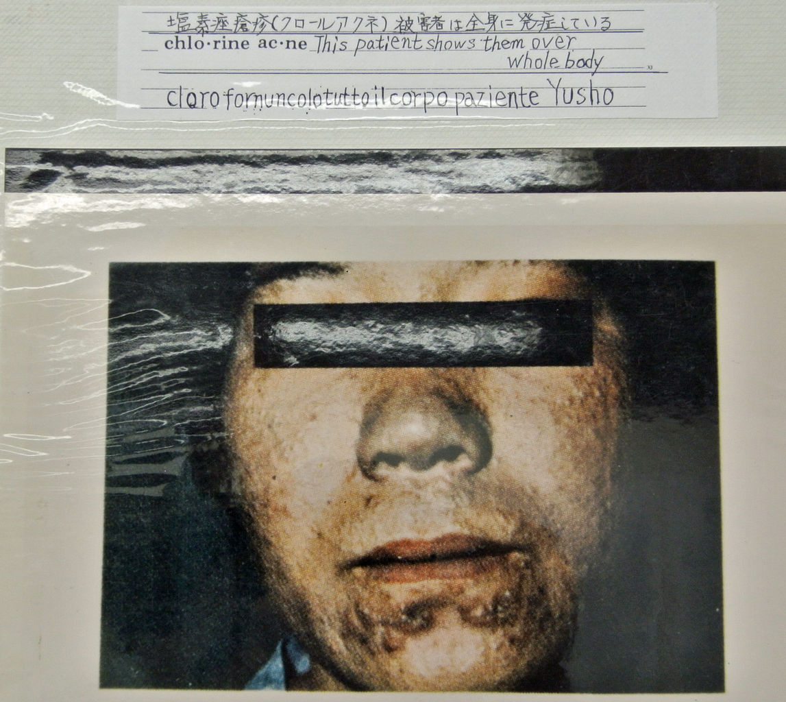 閲覧注意 カネミ油症事件 ダイオキシン被害者の症状画像集 有害物質は土壌 底質に蓄積する 高砂西港のカネカ盛立地を学ぶ