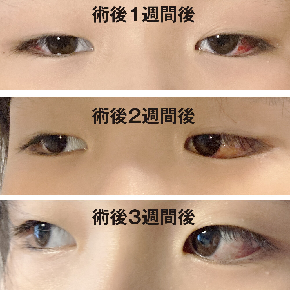 娘の内斜視治療12 最終話 退院 : 漫画 「新ちびといつまでも」〜育児と 暮らしと 乳がんと〜 Powered by ライブドアブログ