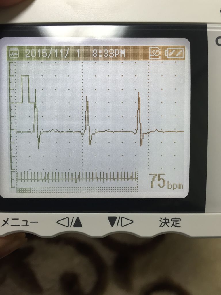 心電図の反時計回転 発作性心房細動根治を目指して