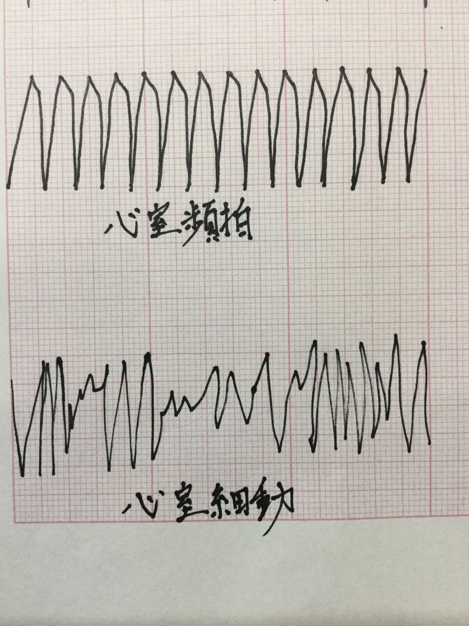 心室細動