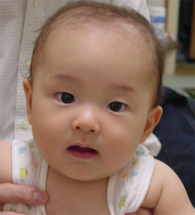 頭の形 耳の形 個性派ってことで 中耳炎ぼーず 頭の形 耳の形 個性派ってことで 中耳炎ぼーず