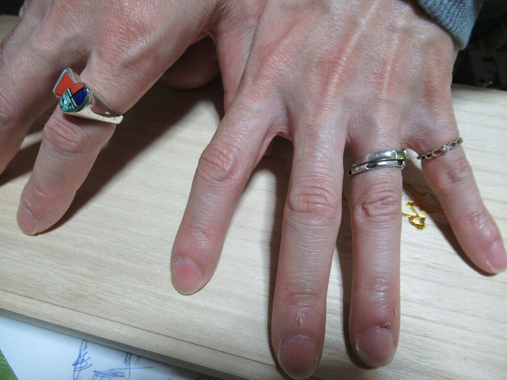 指環 さかむけ ひどいですね 命と絵画と音楽と