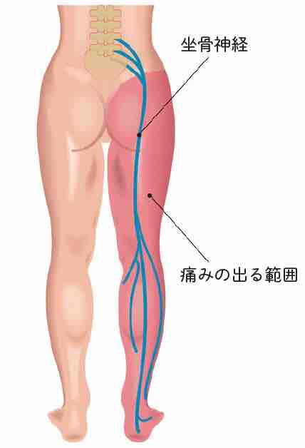 よく聞く坐骨神経痛って 整骨院の先生が書くブログ よく聞く坐骨神経痛って 整骨院の先生が書くブログ