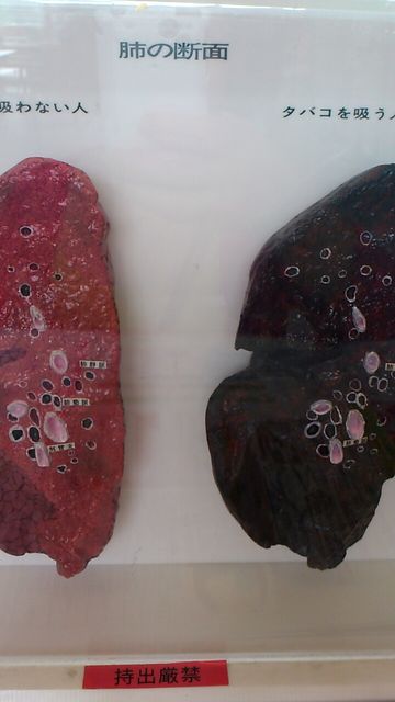 タバコを吸う人の肺の色を見て来ました 能勢慶子 の 絵日記 タバコを吸う人の肺の色を見て来ました 能勢慶子 の 絵日記
