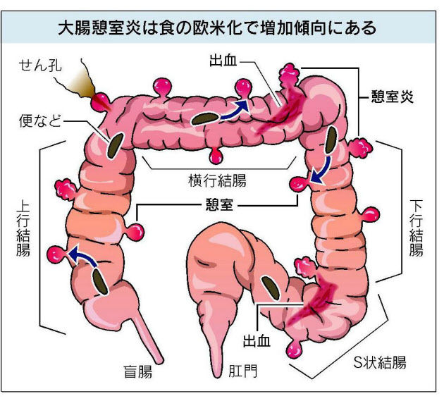 bowel04