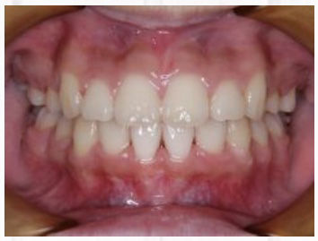 歯列矯正してるやついる 健康ちゃんねる 2ちゃんまとめ