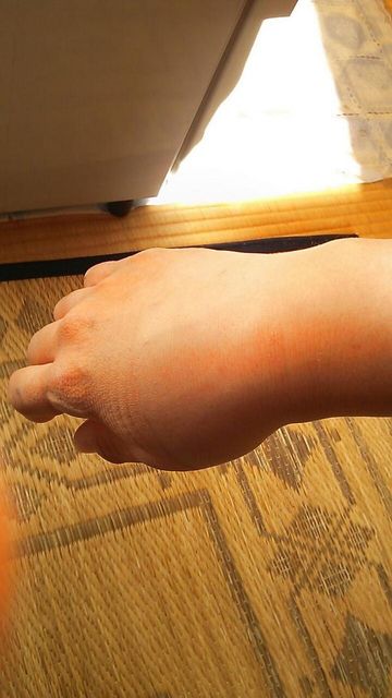 右橈骨遠位端骨折 春夏秋冬眠暁を覚えず 右橈骨遠位端骨折 春夏秋冬眠暁を覚えず