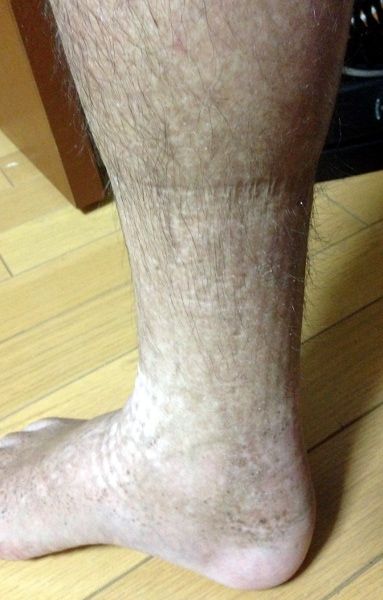 浮腫 むくみ コードが接触不良です Spinal Code Is Poor Contact 浮腫 むくみ コードが接触不良です Spinal Code Is Poor Contact