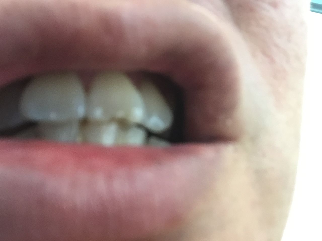 歯が欠けた 館長のつぶやきdiary