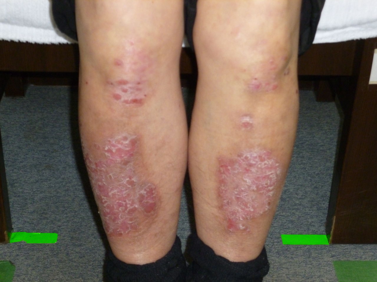 治療日誌ブログ 乾癬 Livedoor Blog ブログ