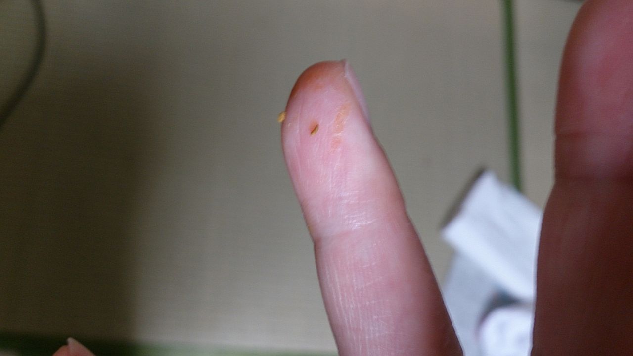 モルジェロンズ病で何が体からでますか Kibyo14のblog モルジェロンズ病で何が体からでますか Kibyo14のblog