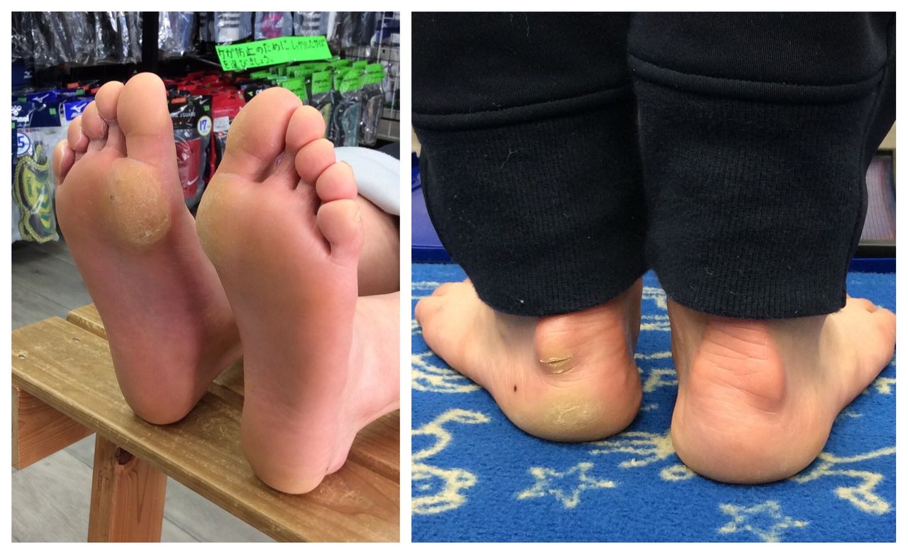 足の痛み 足のマメ タコ いま履いている靴が原因です バランスショップ キック オフ の店長のブログ