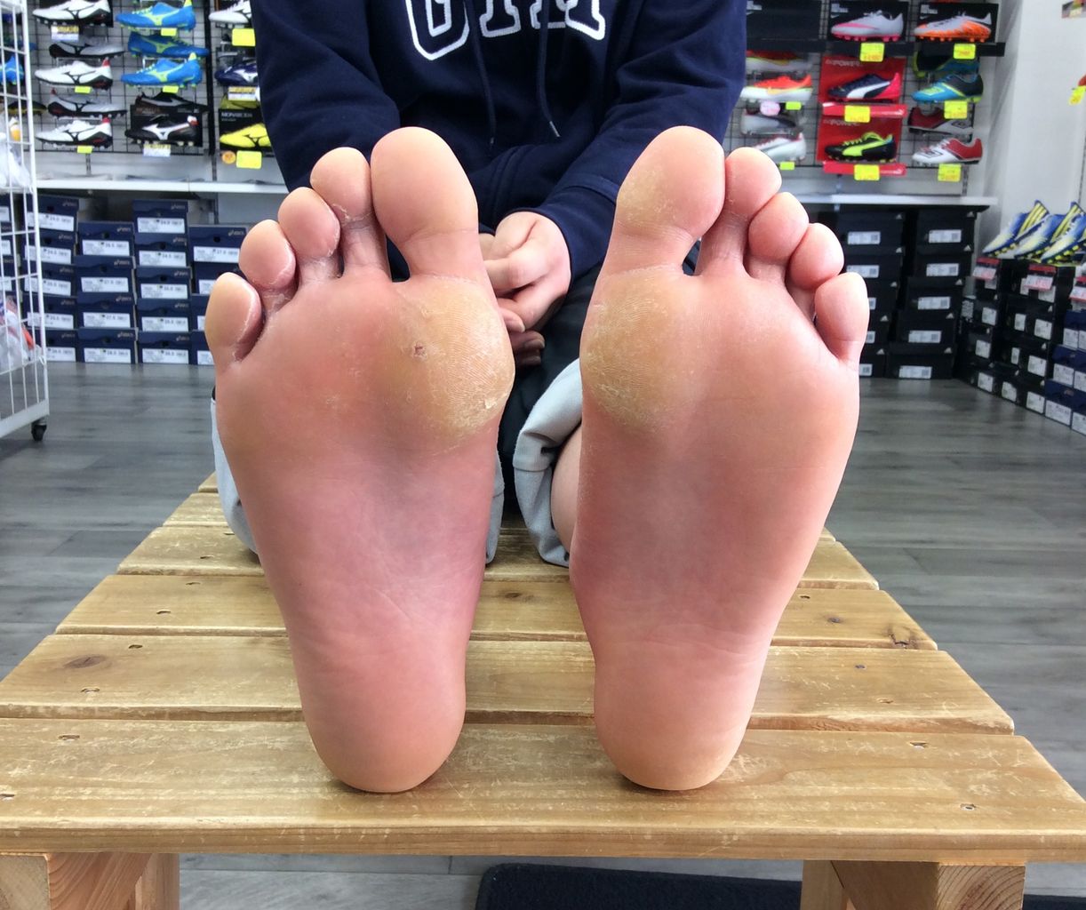 足の痛み 足のマメ タコ いま履いている靴が原因です バランスショップ キック オフ の店長のブログ