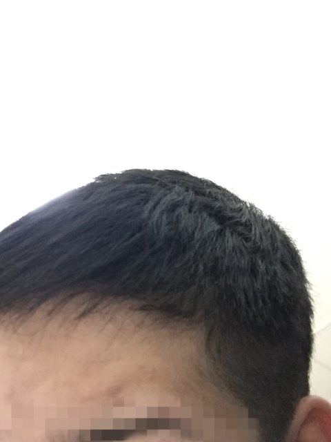 ハゲかけが半年湯シャン続けた結果ｗｗｗｗｗｗ つー速