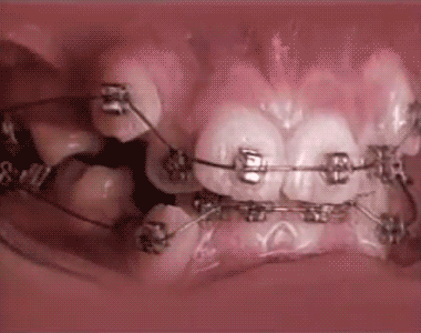 歯列矯正のgif画像ｗｗｗｗｗｗｗｗｗｗｗｗｗｗ つー速