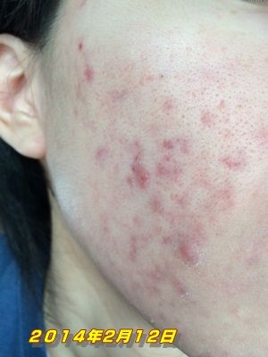 今の状況 花粉とニキビ リプロスキンを６ヶ月使ってからの体験記