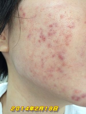 今の状況23 驚くべき角栓の動画 リプロスキンを６ヶ月使ってからの体験記