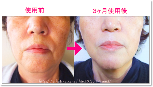 Newaリフト口コミブログ 2か月使用して40代50代顔たるみ解消 家庭用サーマクール美顔器 ネット通販トレンド商品集めてみました