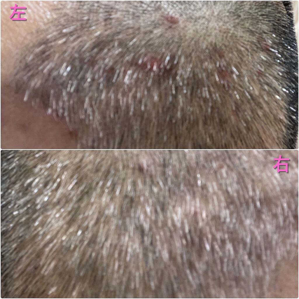 頭皮のニキビ 健康迷走日記